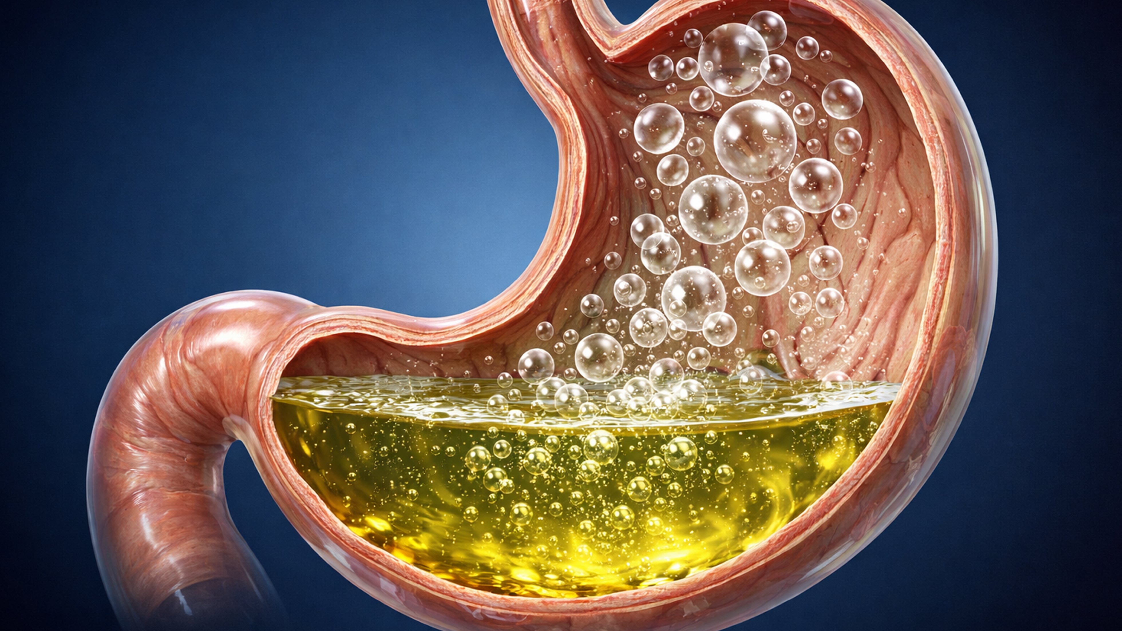 Reflux